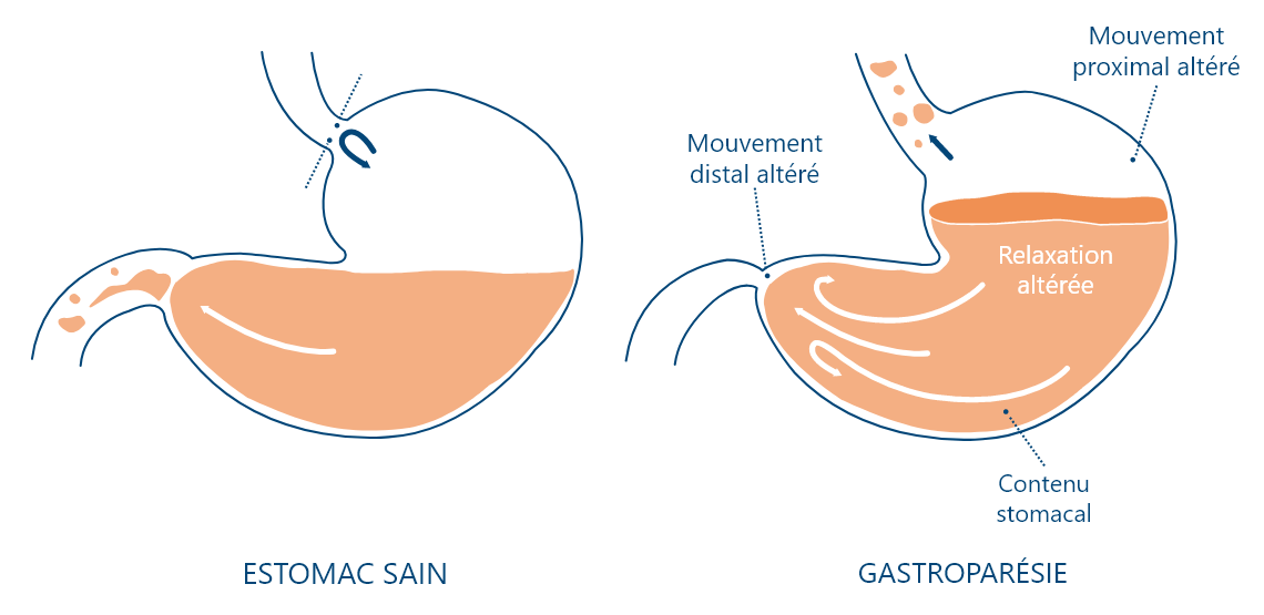  La gastroparésie touche 90 % des patients parkinsoniens.